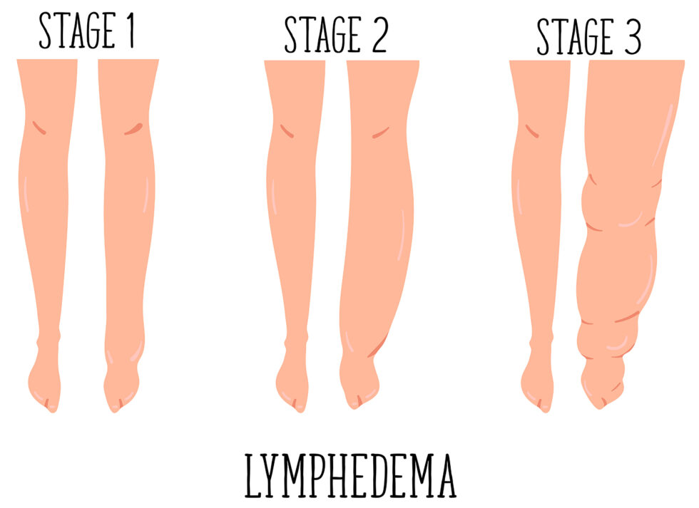 What Is Vein Disease And Lymphedema American Venous Forum Hot Sex Picture