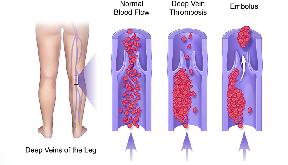 What is Deep Vein Thrombosis?